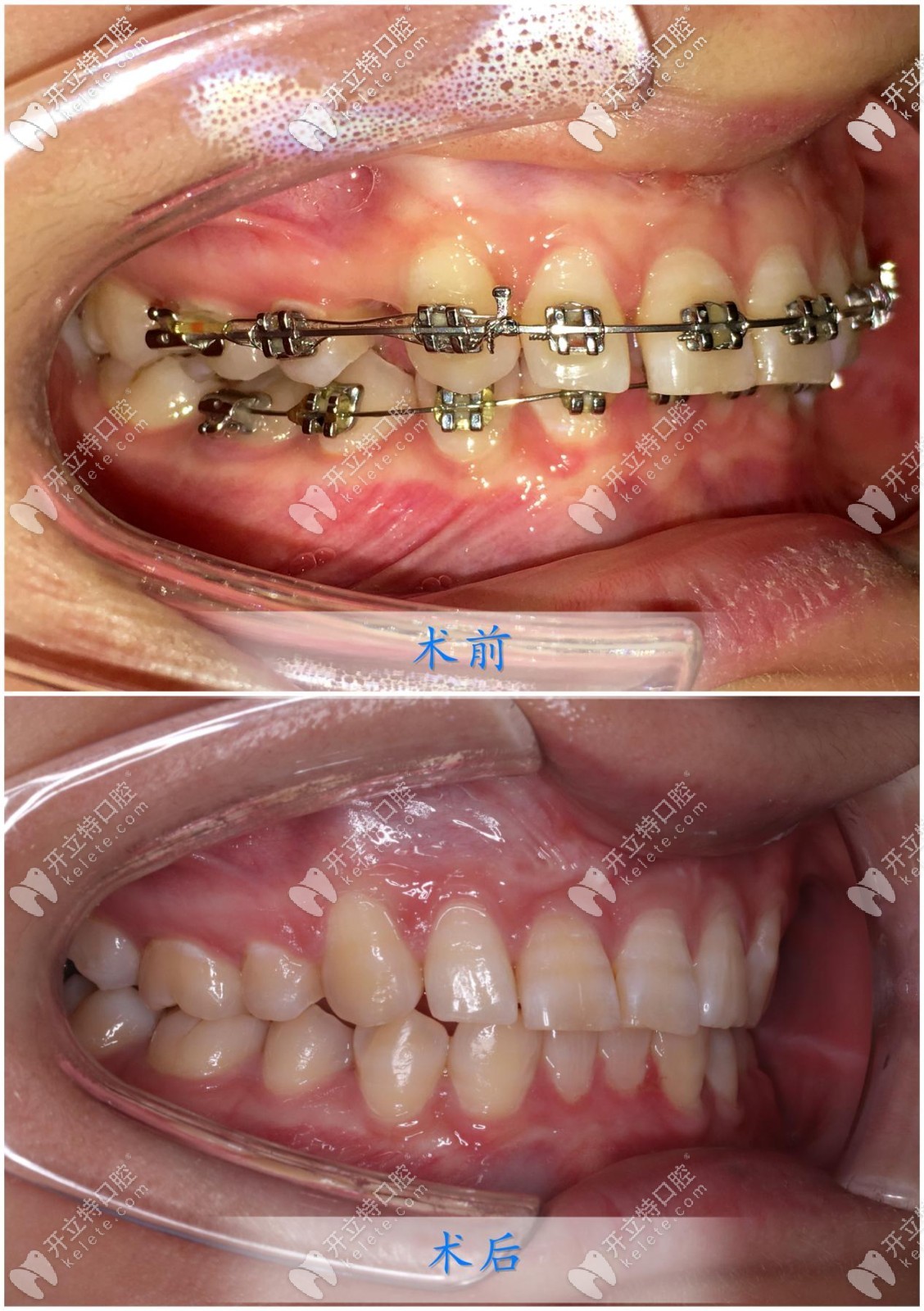 [凸嘴+深覆合矯正日記](méi)選金屬方絲弓托槽正畸效果也不錯(cuò)