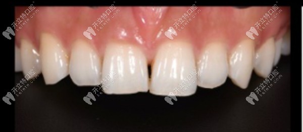 閨蜜門牙牙縫大