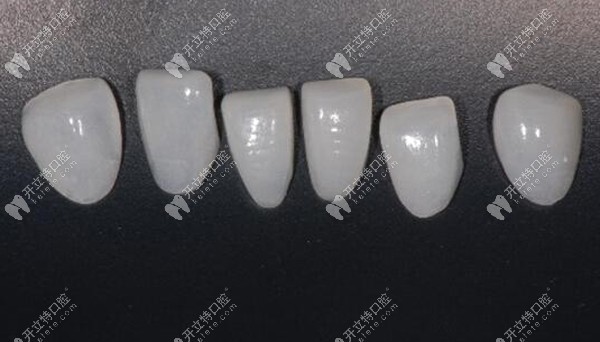 超薄全瓷牙貼面