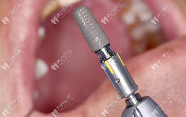 康盛種植體實物圖