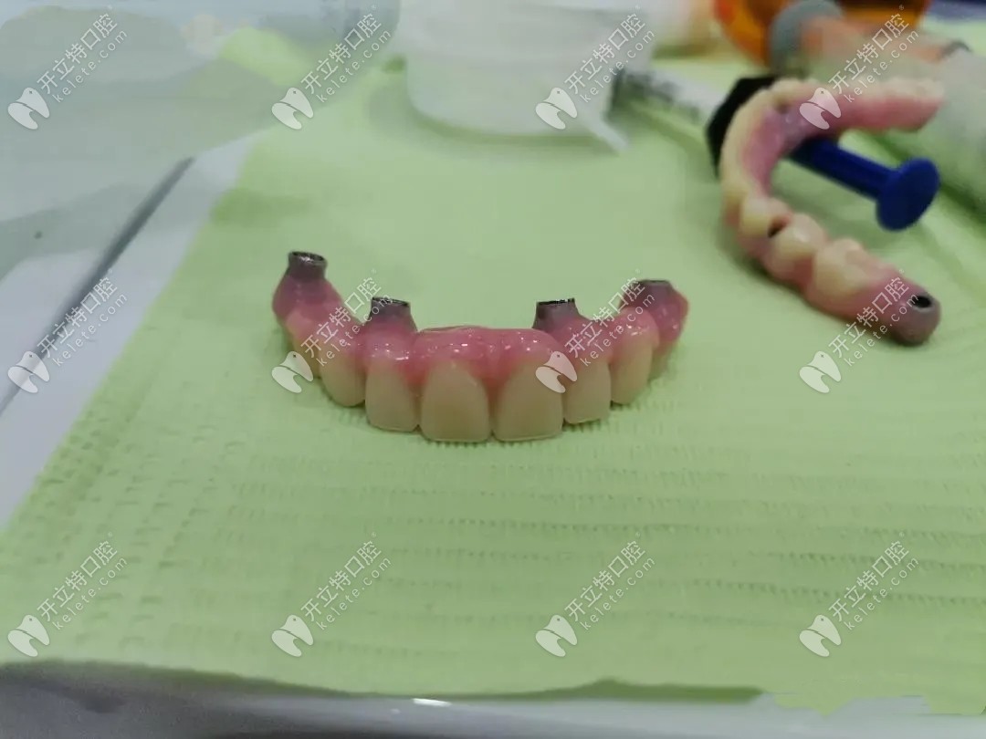 種植牙牙冠 種植牙牙冠