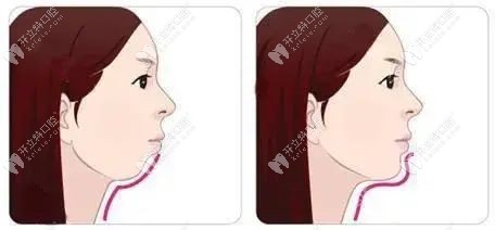 做了金屬固定矯正后我的下巴有了曲線