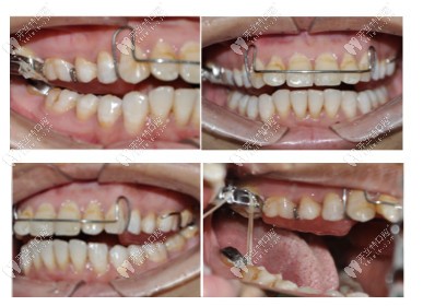 去維樂口腔剛戴上牙套的正側(cè)面圖片