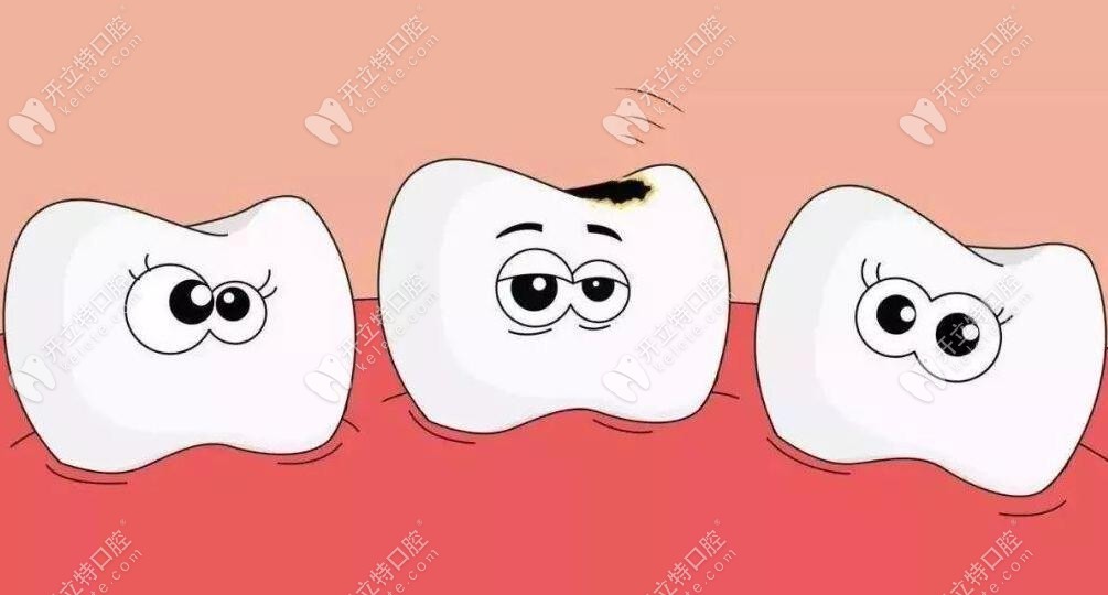 后面大牙齲壞補洞