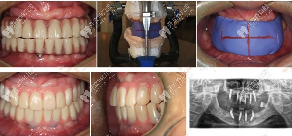 植入植體后口內(nèi)的情況