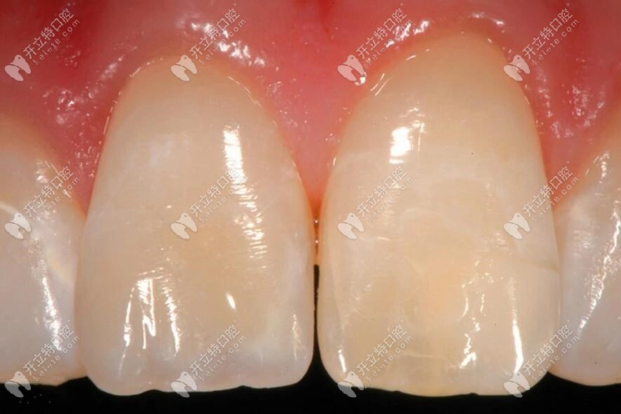 美塑補牙后效果圖