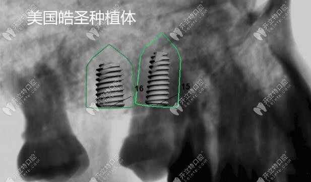 上頜竇區(qū)用美國皓圣種植體