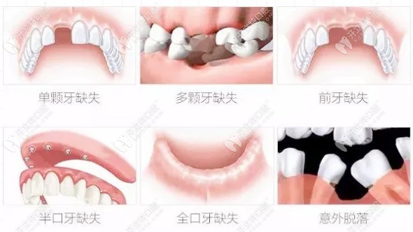 需要種植牙的幾種癥狀