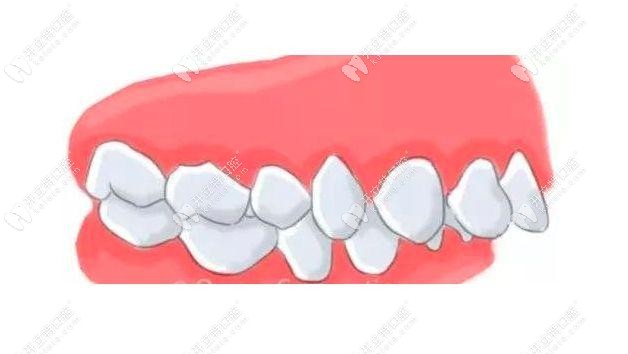 凸嘴癥狀-上頜突出