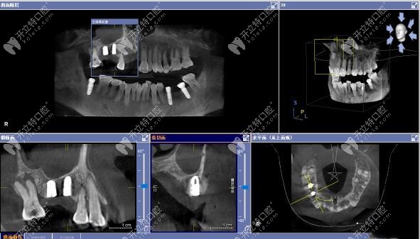 3D數字化導板上頜竇區(qū)種植案例
