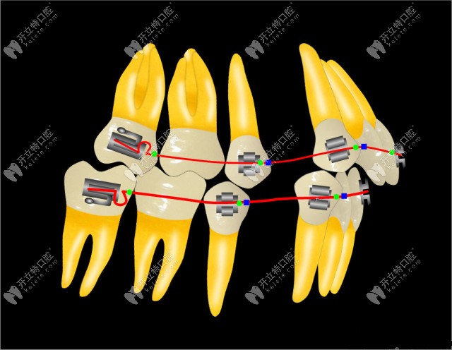 針對于重度錯頜畸形的Tweed-Merrfield定向力矯正技術有何特點