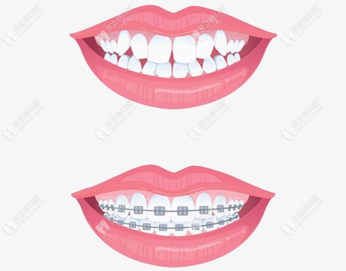 牙齒矯正前后對比