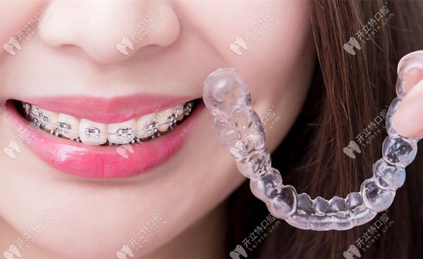 金屬矯正器和隱形矯正器的佩戴效果圖 金屬矯正器和隱形矯正器的佩戴效果圖