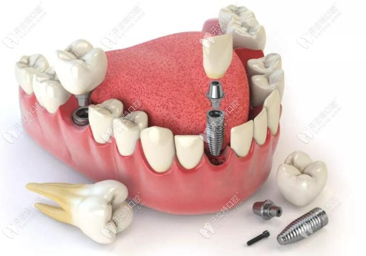 種植牙結(jié)構(gòu)示意圖