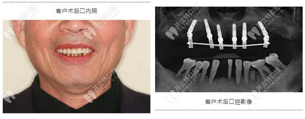 采用allon6即刻負(fù)重技術(shù)恢復(fù)了上半口牙