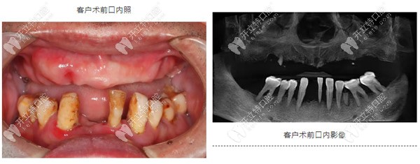 重度牙周炎導(dǎo)致上頜牙齒缺失