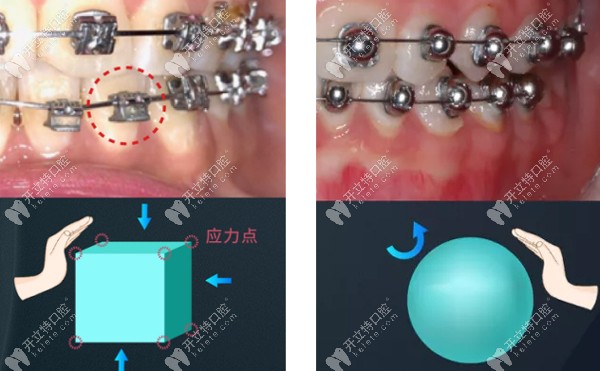 球面自鎖托槽脫落概率小