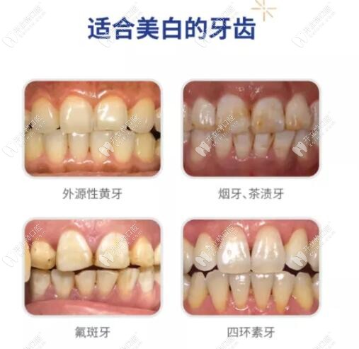 牙齒美白適應癥