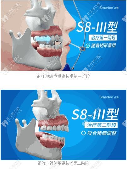 正雅S8、S9、S10頜位重建術(shù)