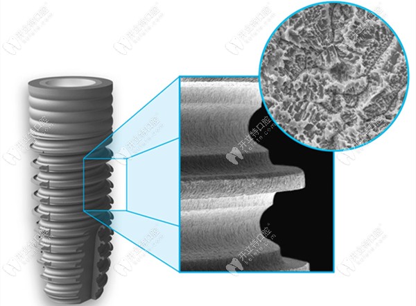 西傲種植體的細節(jié)展示
