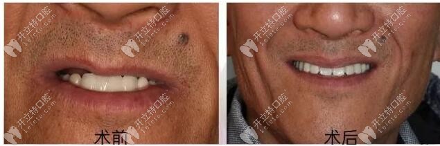 老人半口修復成功 老人半口修復成功