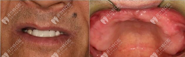 老人上頜無牙 老人上頜無牙