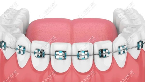 秦曉中談成人牙齒矯正為何有難度