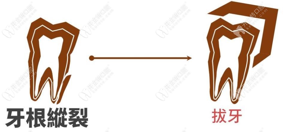 牙根縱裂需要拔牙哦