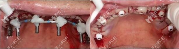 定位種植位點 定位種植位點