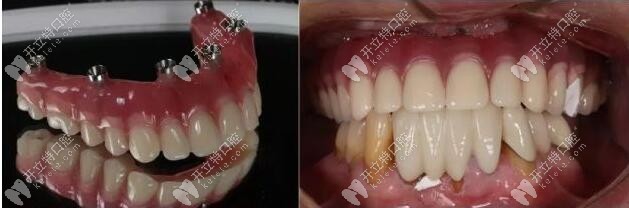 即刻修復體 即刻修復體