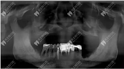 拍片檢查上頜位置 拍片檢查上頜位置