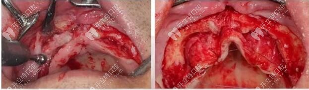 局麻后切開 局麻后切開