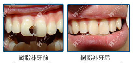 樹脂補(bǔ)牙前后對(duì)比