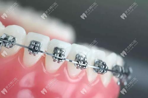 牙齒矯正示意圖