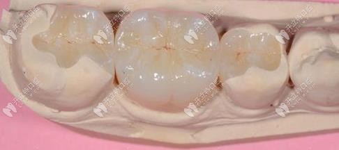 樹脂補(bǔ)牙外觀圖