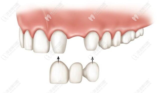 固定假牙修復(fù)技術(shù)