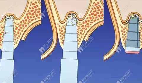 種植牙填充骨粉