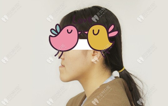 骨性三類地包天的側(cè)貌