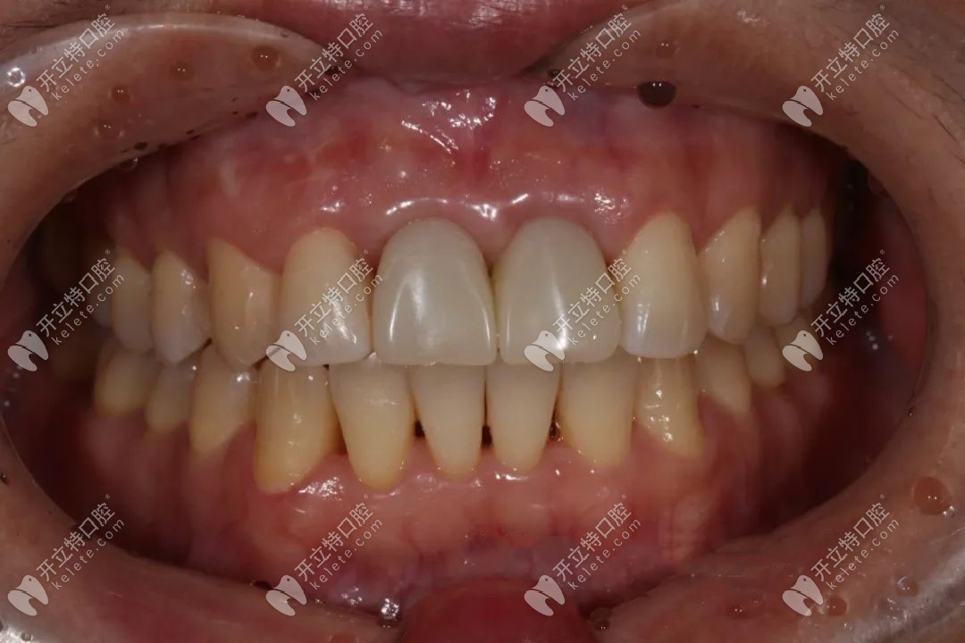 顧客臨時(shí)牙佩戴后情況