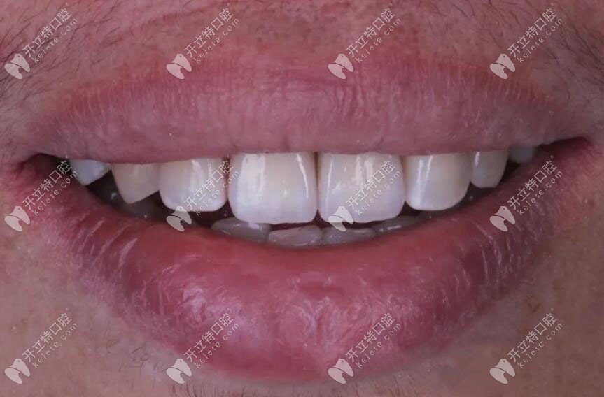 種植牙完成修復(fù)后的情況