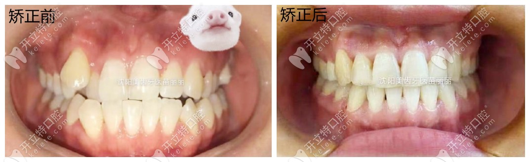 矯正前后對比圖