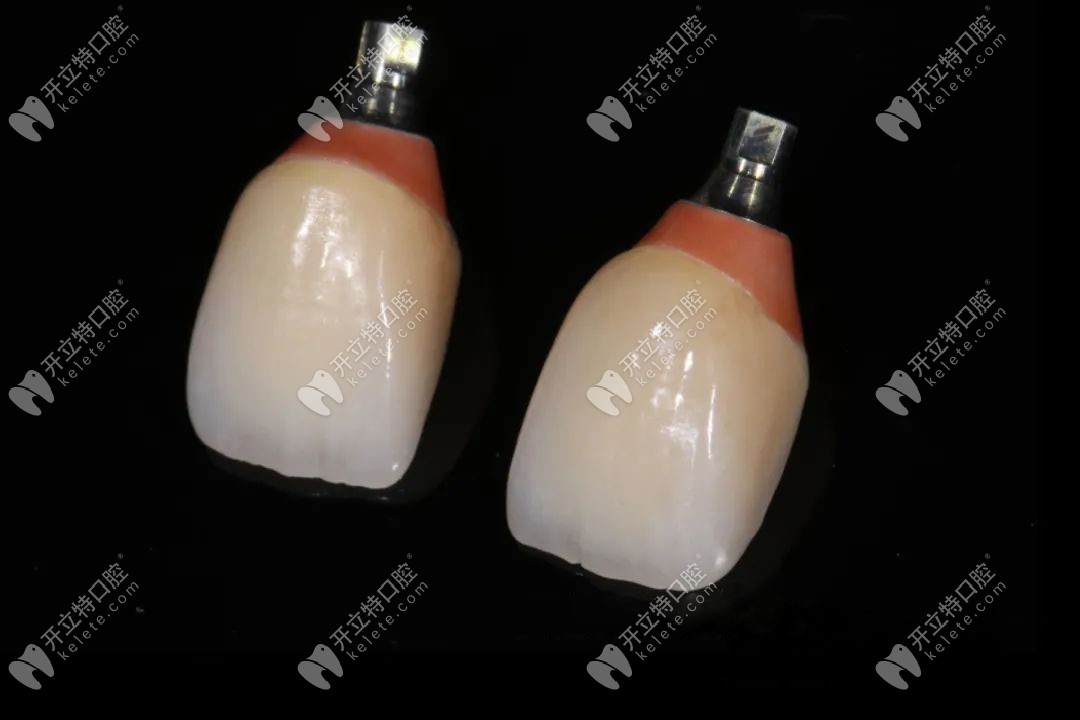 種植后長久性牙冠的修復(fù)