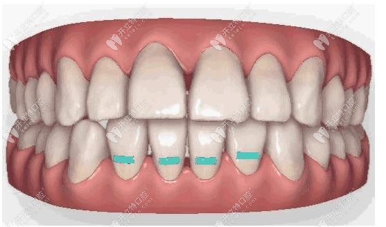 隱適美隱形矯正牙套適合做磨牙后推矯正